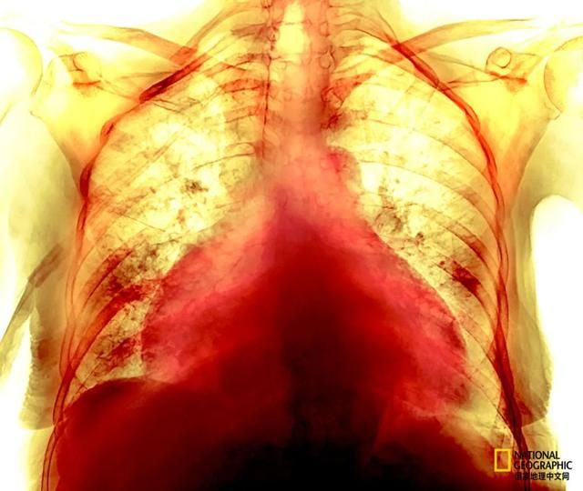 为什么有些人不会得新冠? 为什么有些人不会得新冠?