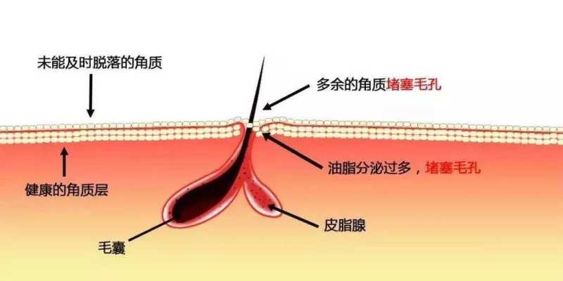 如何解救「大油田」？清爽男士必备的控油答案在此
