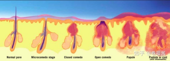 这篇完整版战「痘」攻略,可以分享给身边的易长痘星人 这篇完整版战「痘」攻略,可以分享给身边的易长痘星人